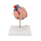 Classic Human Heart Model with Left Ventricular Hypertrophy (LVH), 2 part