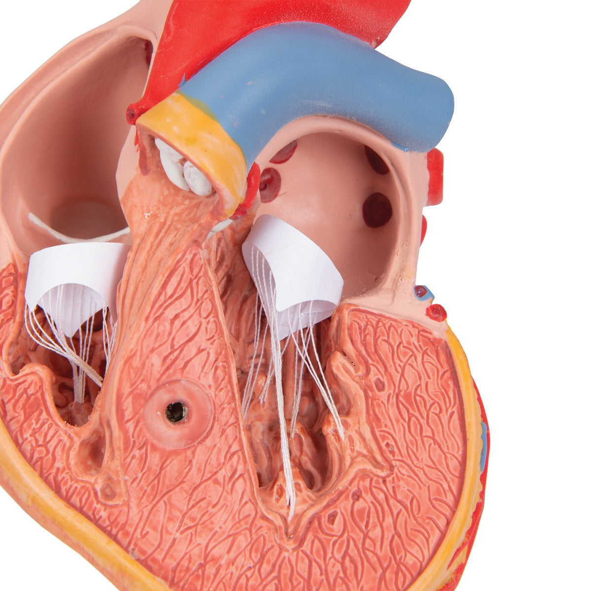 Classic Human Heart Model with Left Ventricular Hypertrophy (LVH), 2 part