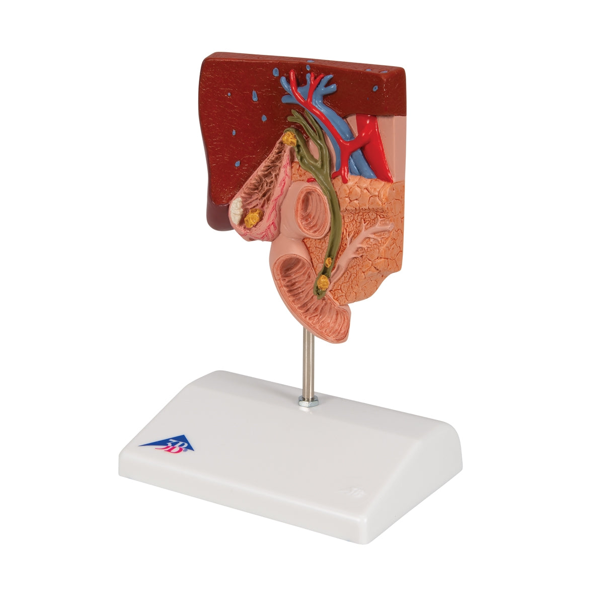 Gallstone Model