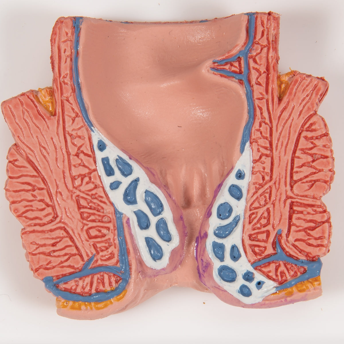 Hemorrhoid Model