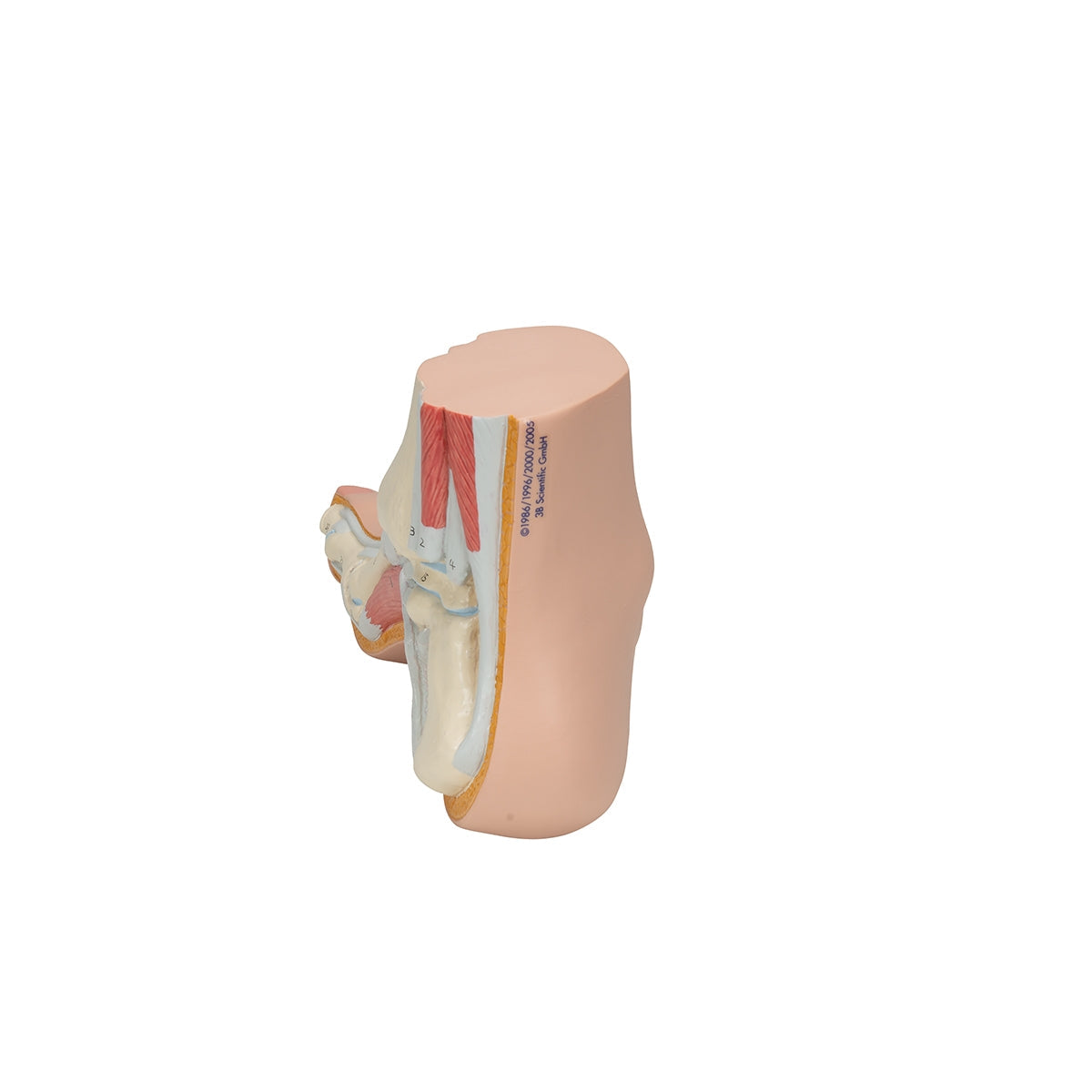 Hollow Foot (Pes Cavus) Model