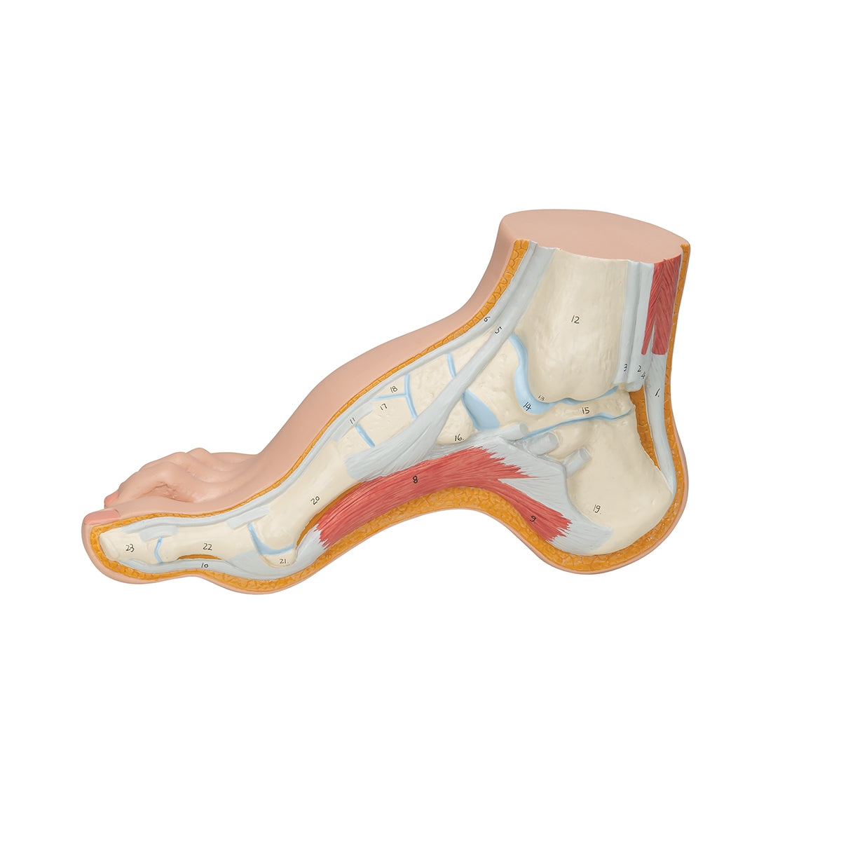 Hollow Foot (Pes Cavus) Model