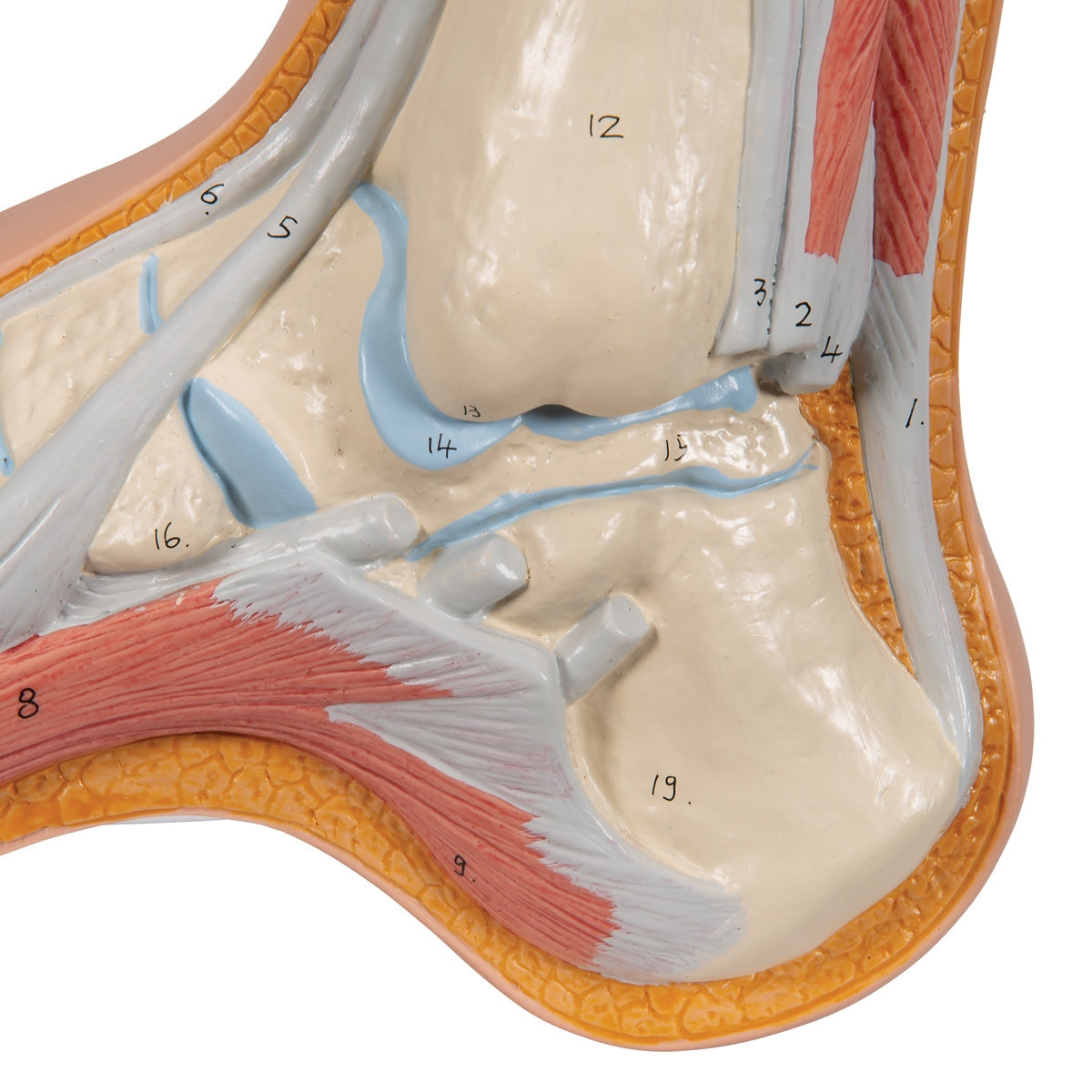 Hollow Foot (Pes Cavus) Model