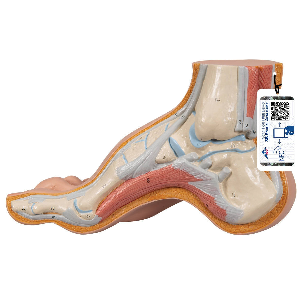 Hollow Foot (Pes Cavus) Model