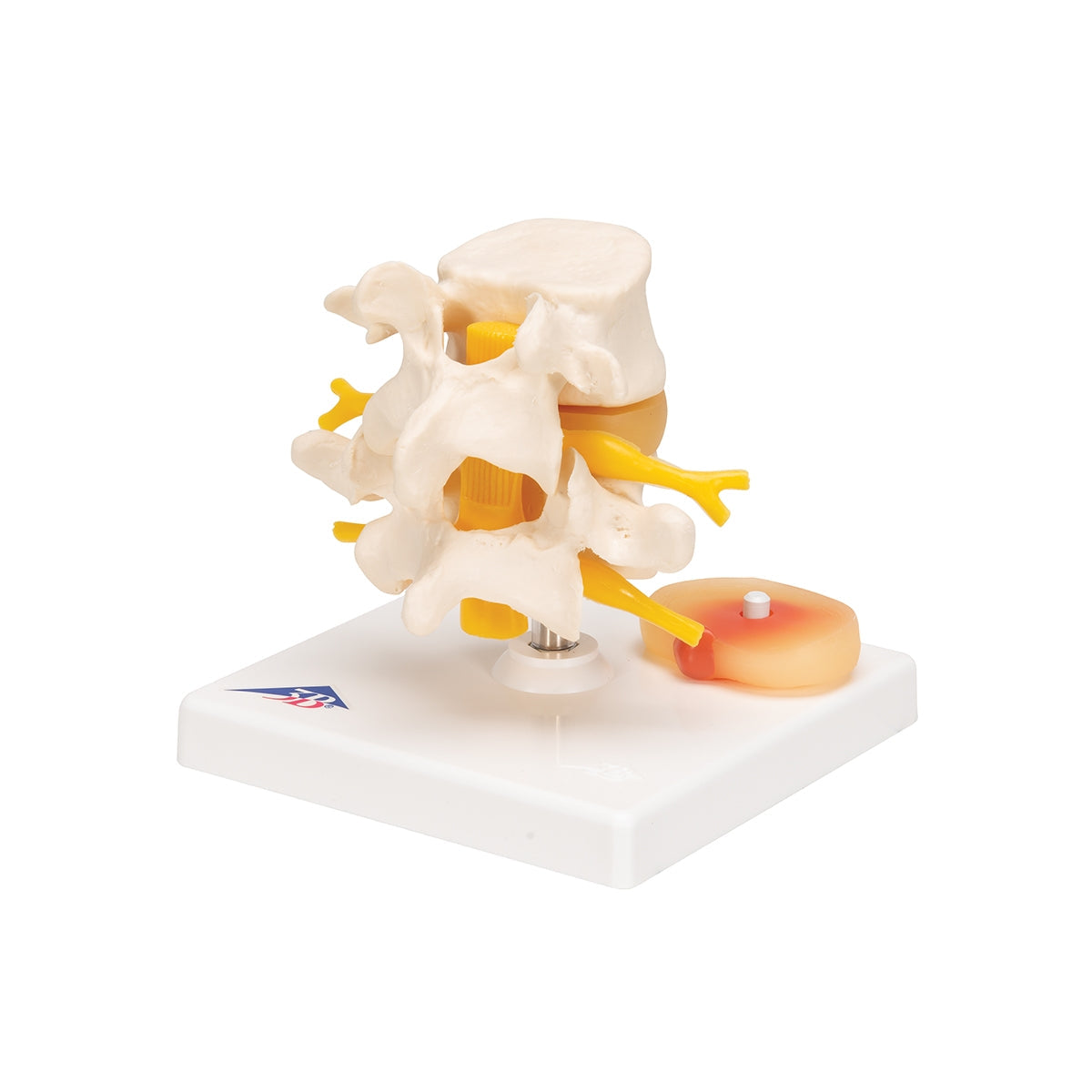 Human Lumbar Spinal Column with Prolapsed Intervertebral Disc