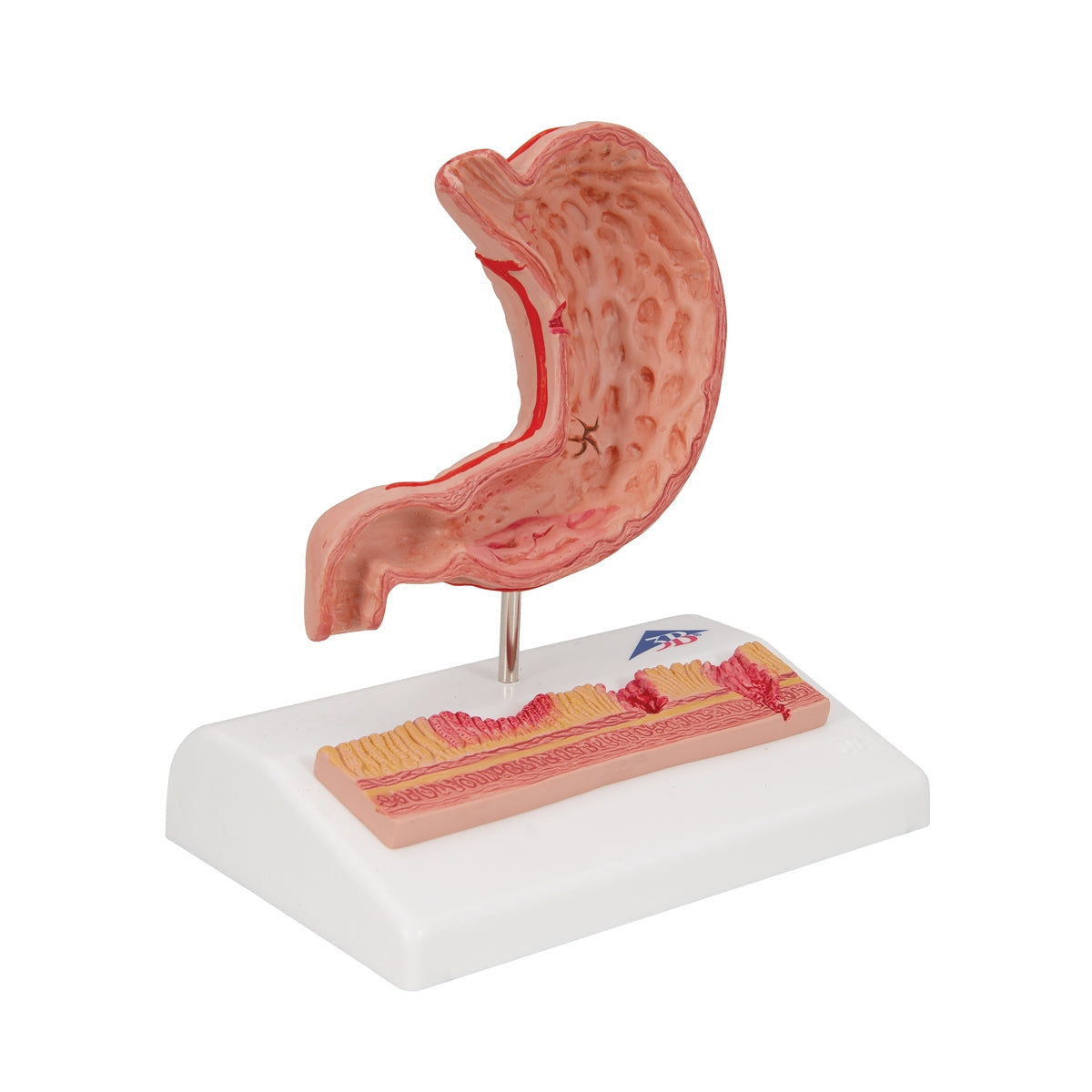 Human Stomach Section Model with Ulcers