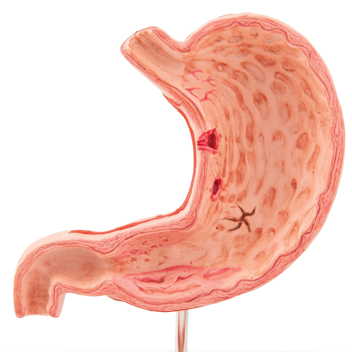 Human Stomach Section Model with Ulcers