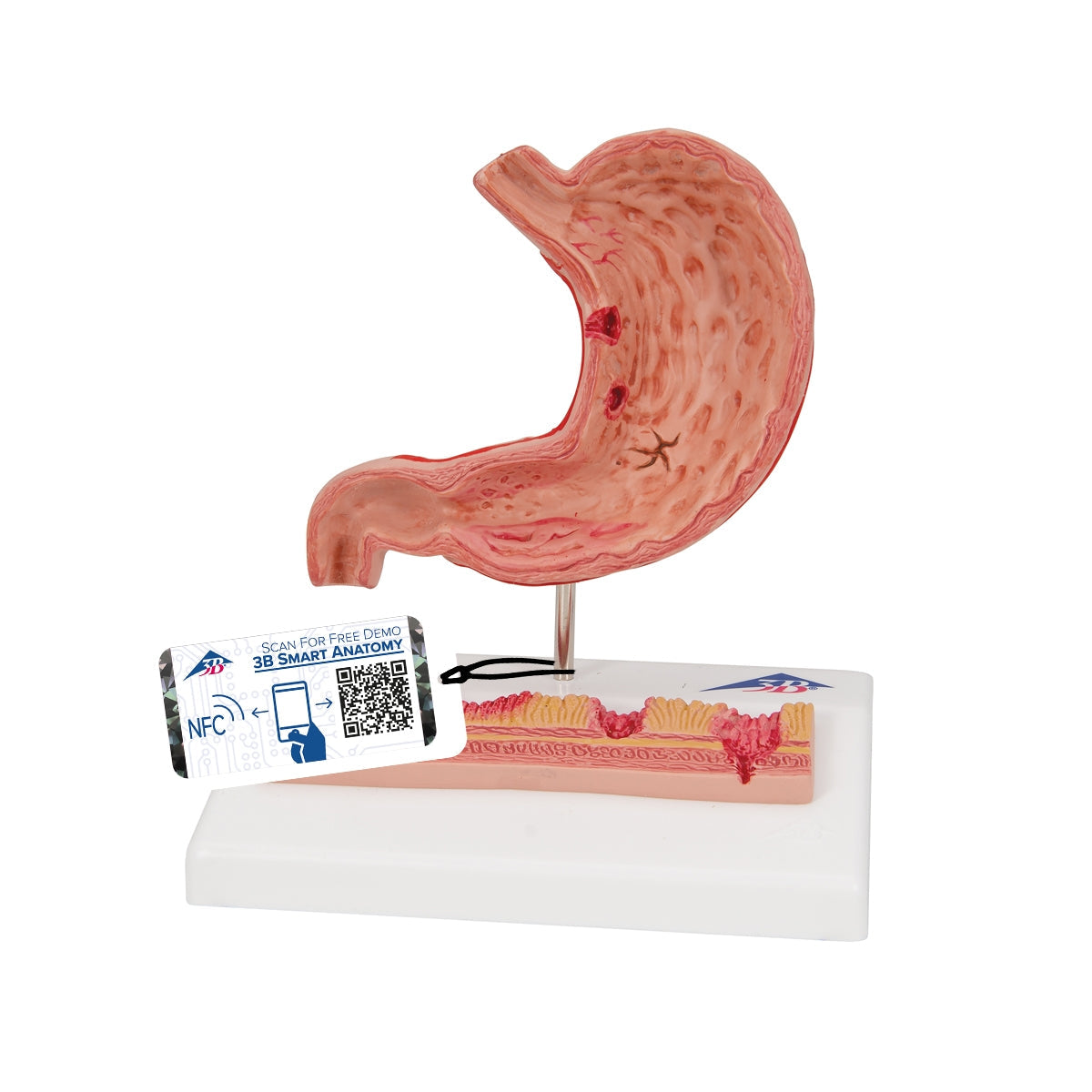 Human Stomach Section Model with Ulcers