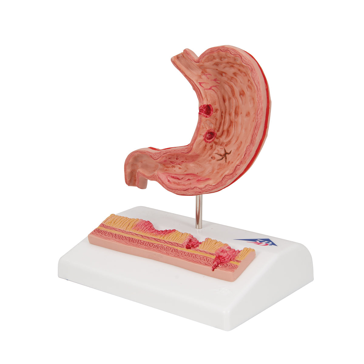 Human Stomach Section Model with Ulcers