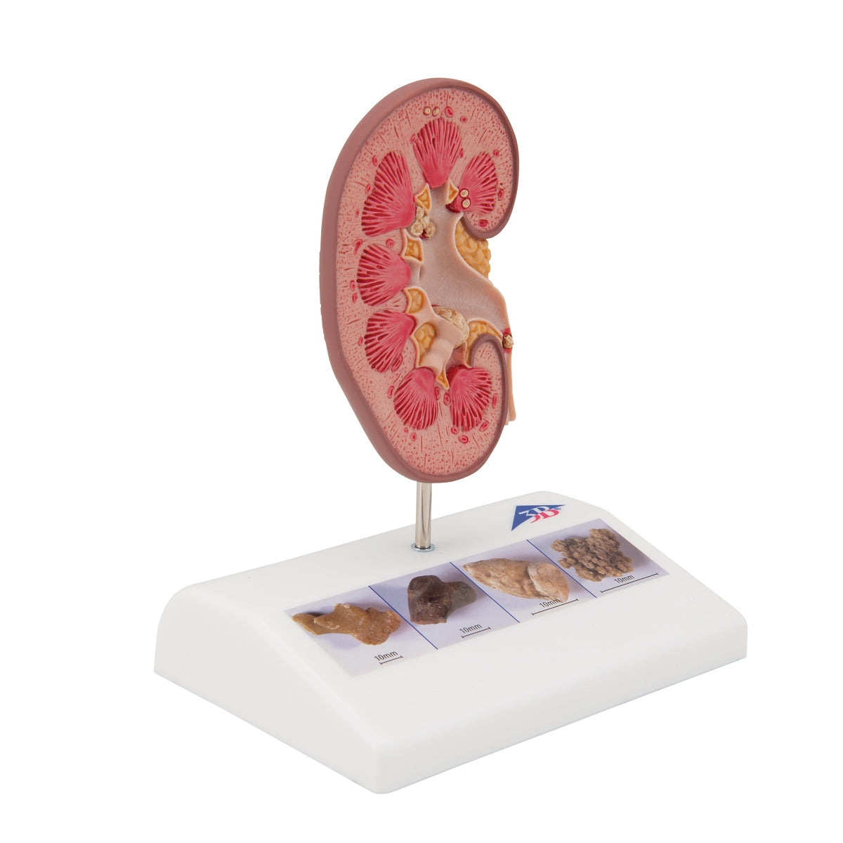 Kidney Stone Model