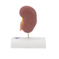 Kidney Stone Model