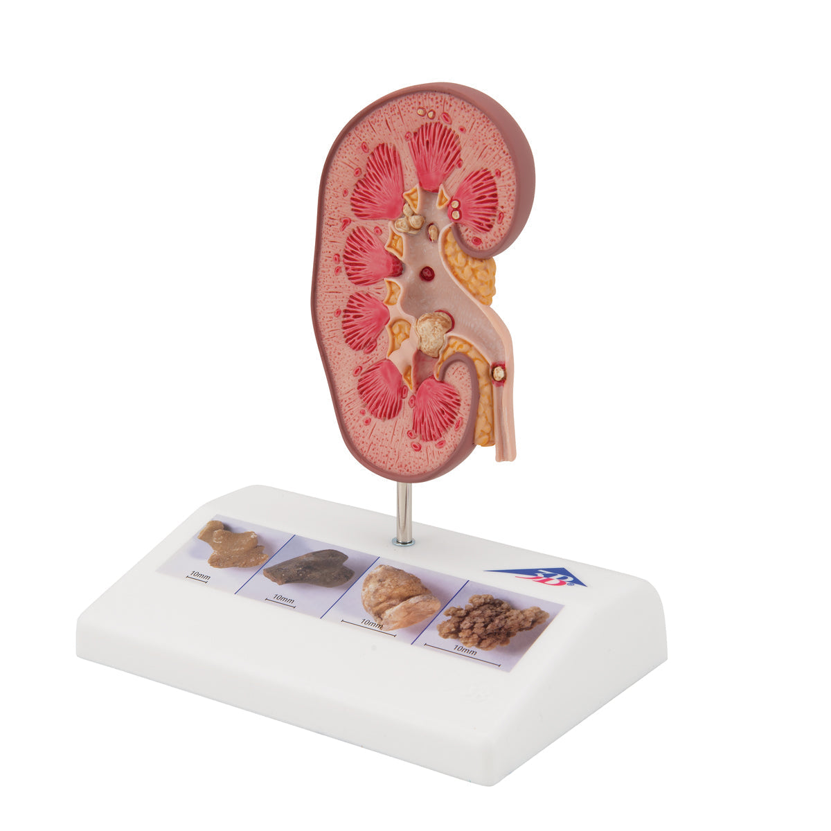 Kidney Stone Model