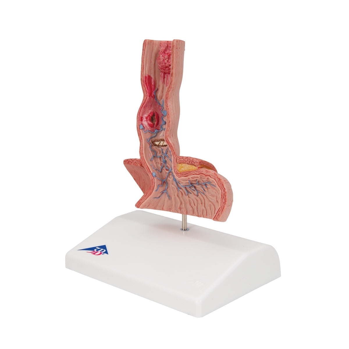 Life-Size Human Esophagus Diseases Model