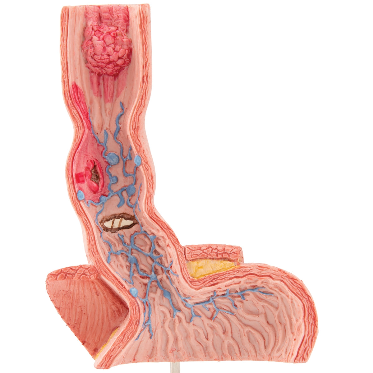 Life-Size Human Esophagus Diseases Model