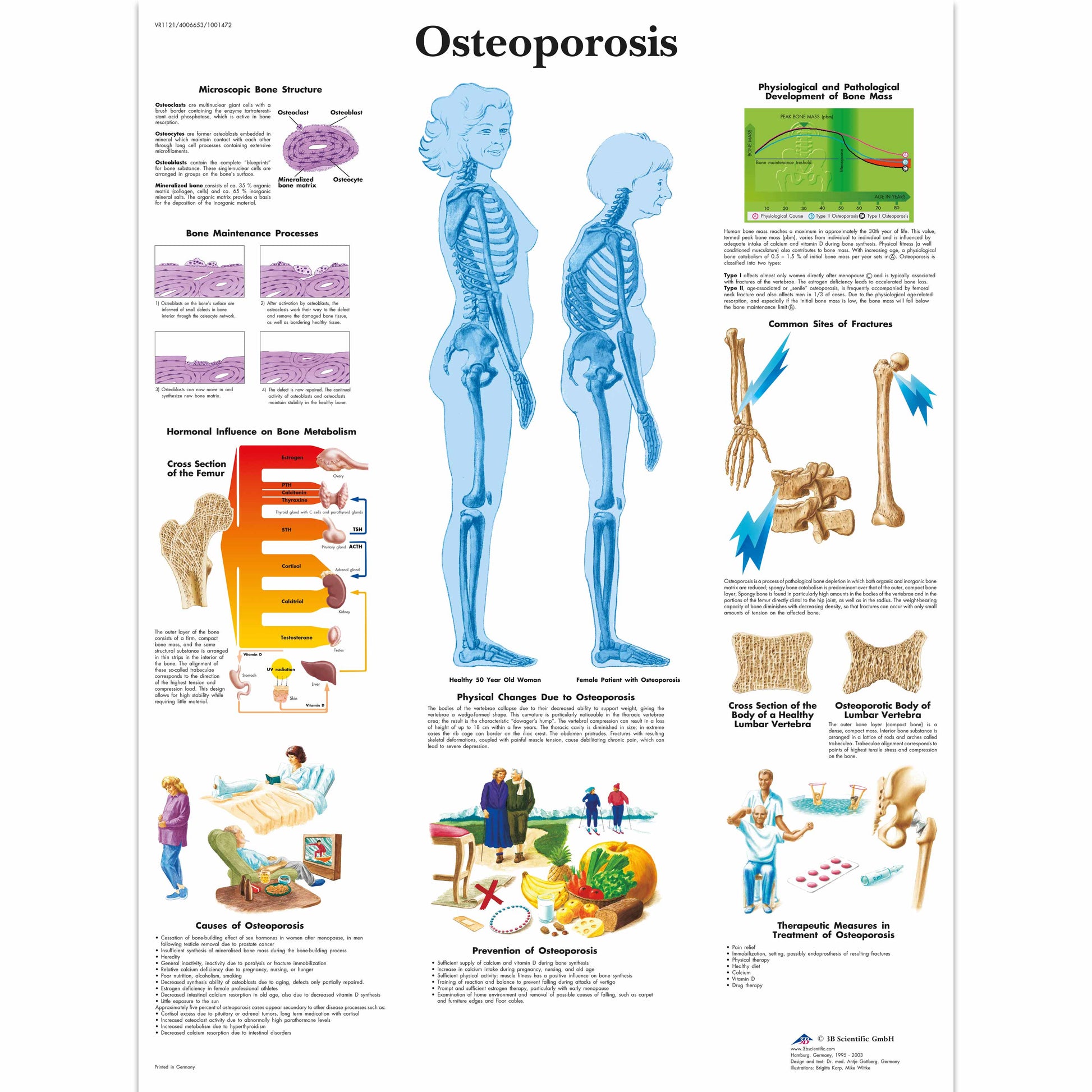 Osteoporosis Chart