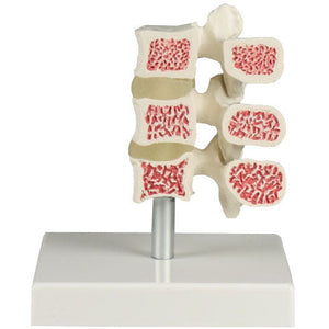 Osteoporosis Vertebrae Model - 3 Vertebrae