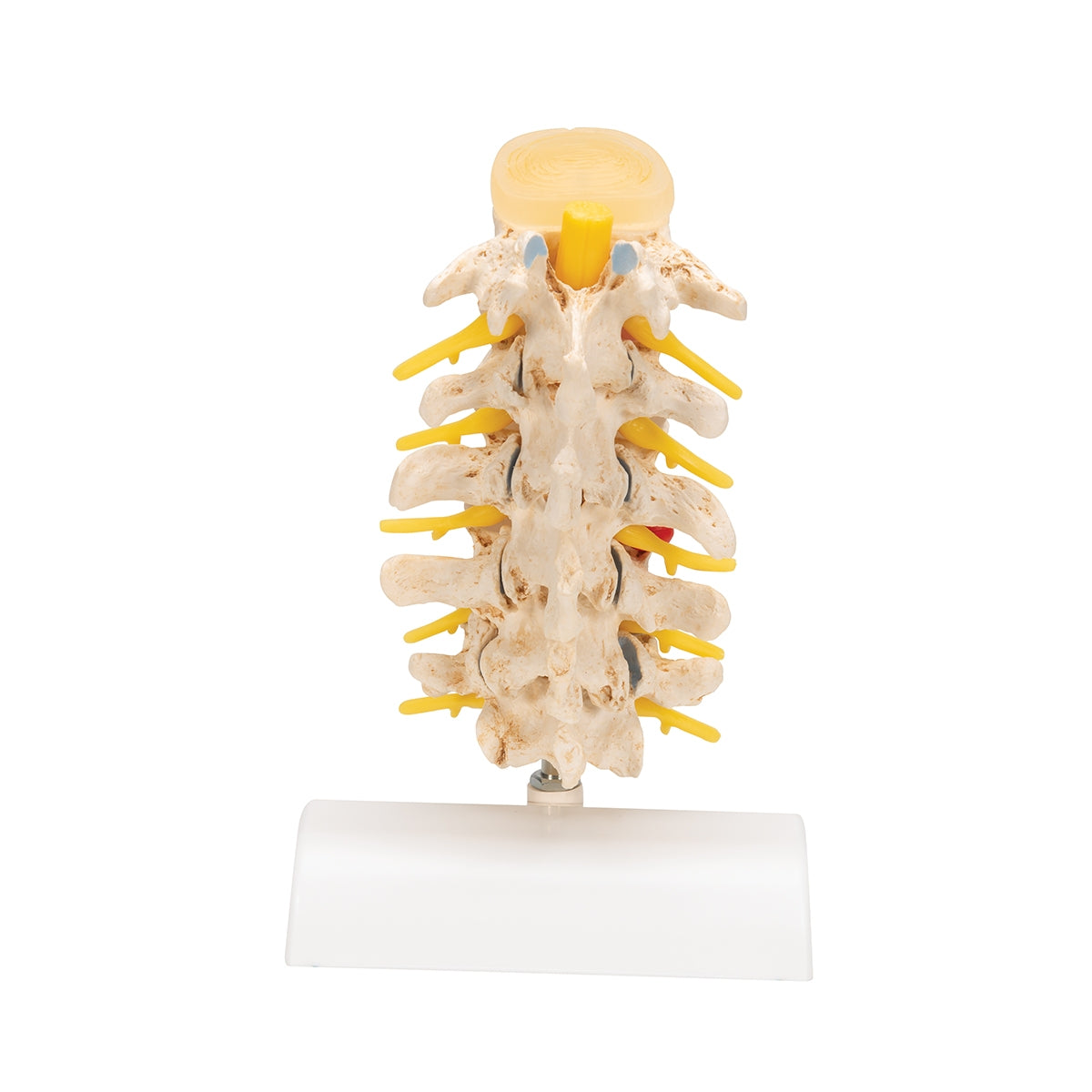 Stages of Disc Prolapse and Vertebral Degeneration