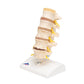 Stages of Disc Prolapse and Vertebral Degeneration