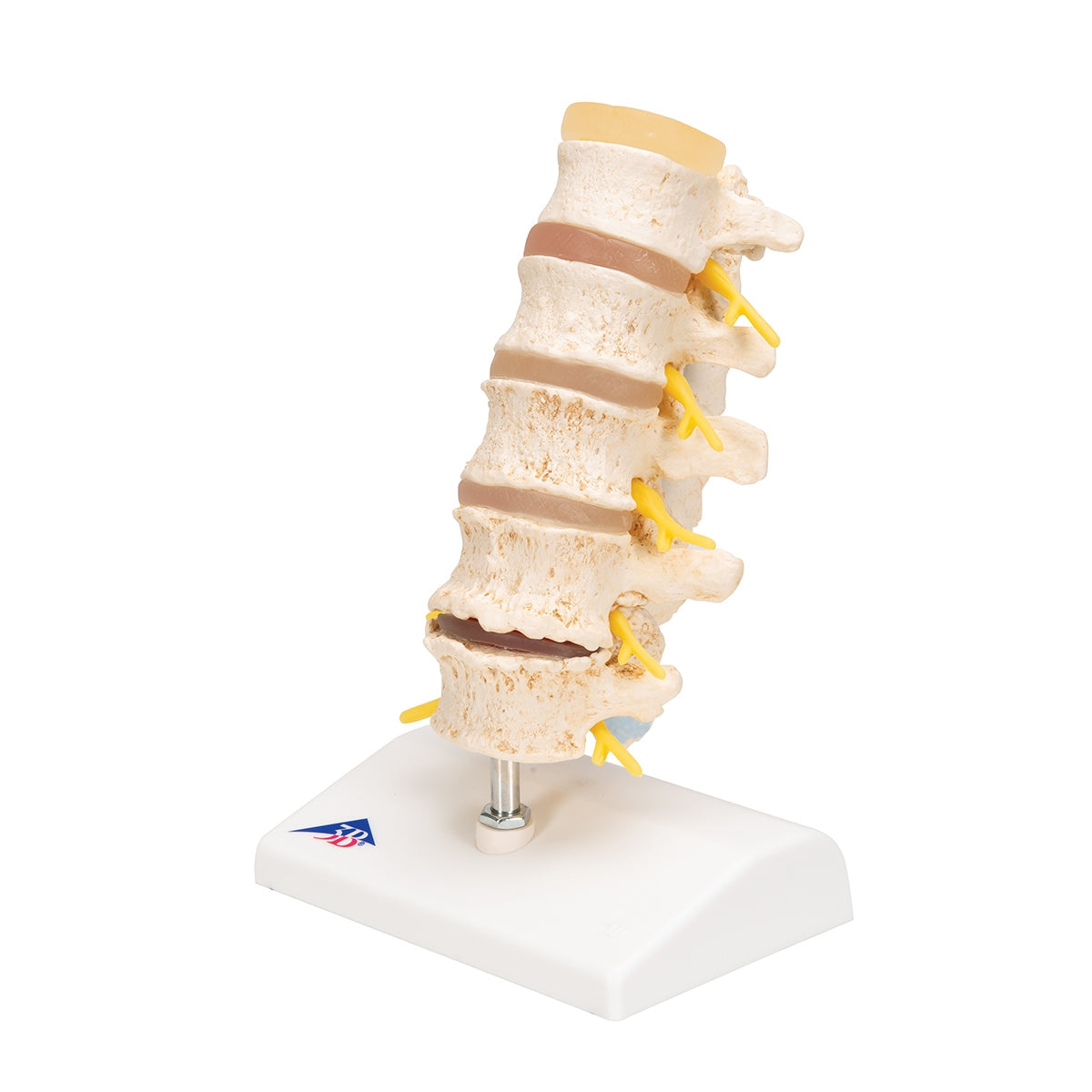 Stages of Disc Prolapse and Vertebral Degeneration