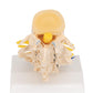 Stages of Disc Prolapse and Vertebral Degeneration