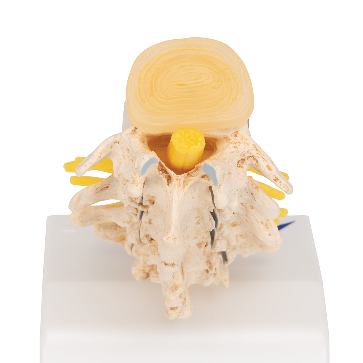 Stages of Disc Prolapse and Vertebral Degeneration