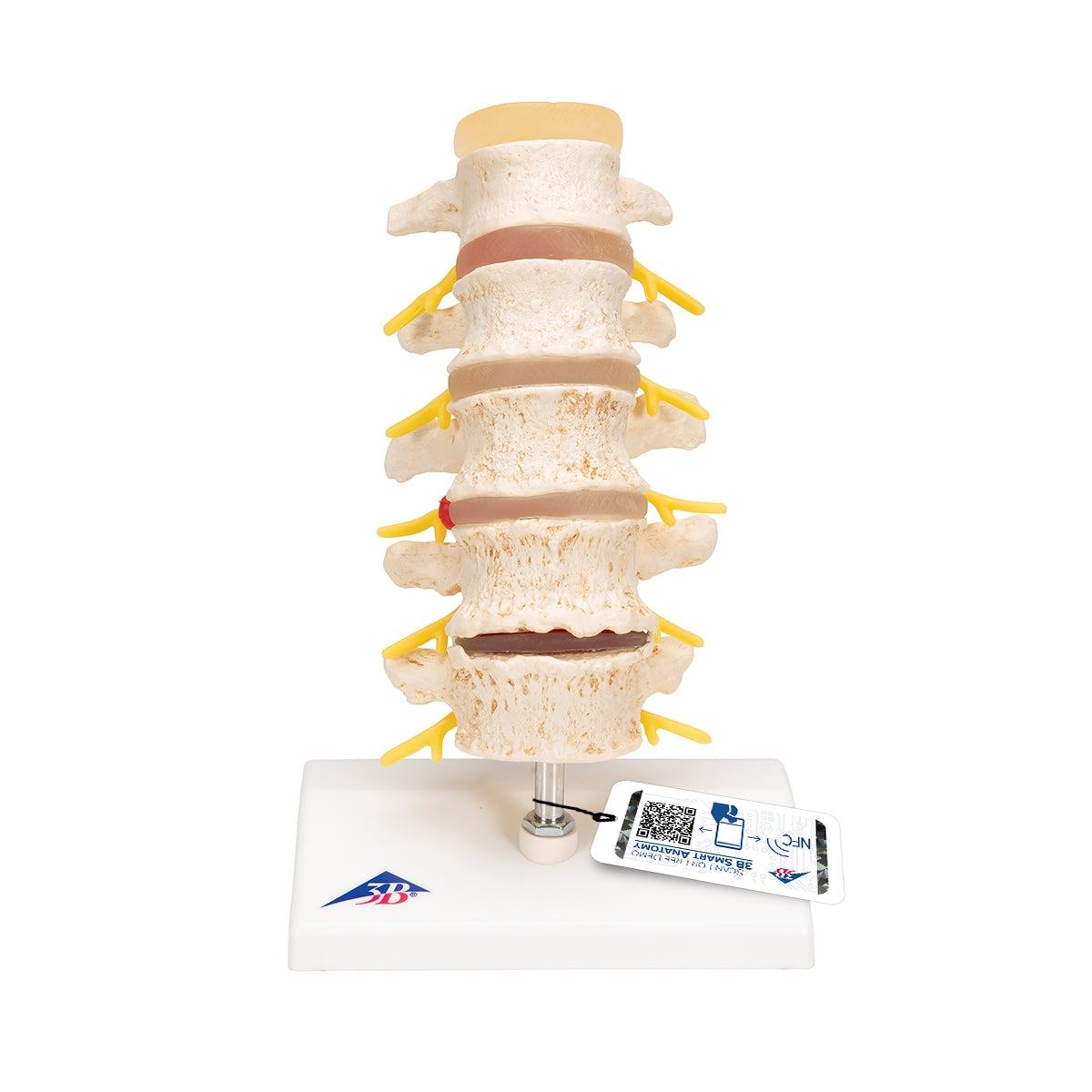 Stages of Disc Prolapse and Vertebral Degeneration