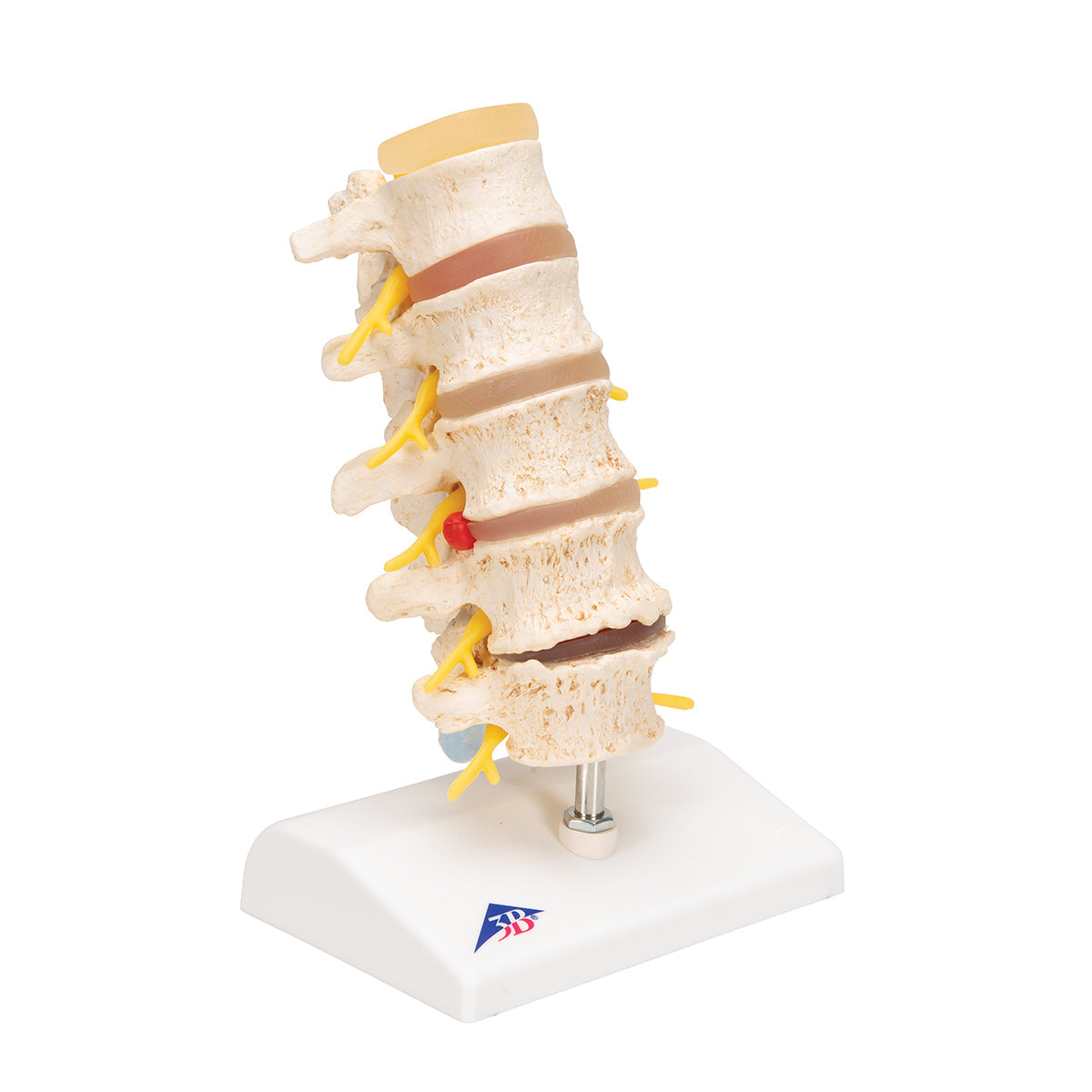 Stages of Disc Prolapse and Vertebral Degeneration