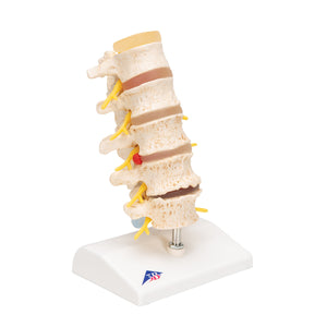 Stages of Disc Prolapse and Vertebral Degeneration