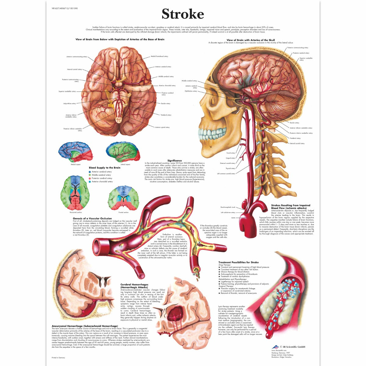 Stroke Chart