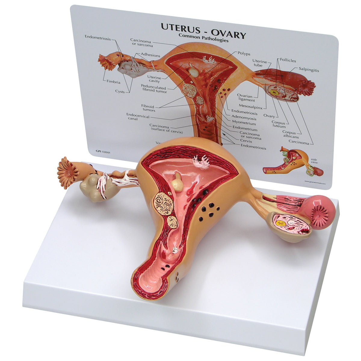 Uterus-Ovary Model